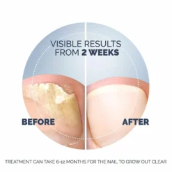 Scholl Kalknagel Behandelset -Gezondheidsproducten Winkel 1053908 6